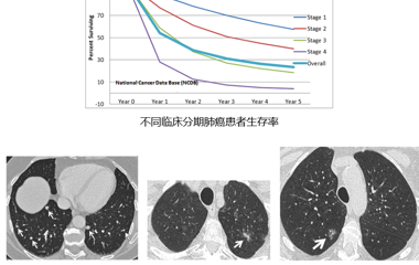 基于CT影像的肺结节实性成分密度细粒度智能分析